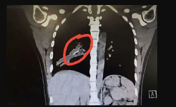 O fată de 14 ani suferea de o tuse dureroasă cauzată de pui în plămâni.